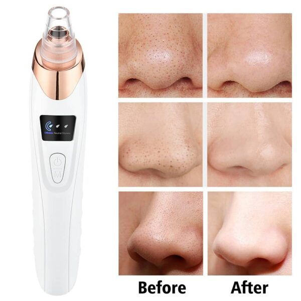 5 in 1 Blackhead remover | Derma Suction | Rechargeable | Free Gift Card 🎁